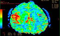 میزان امید به زندگی در مرحله‌ی 4 سرطان مغز