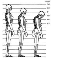 اینفوگرافی/چگونه از کوتاه شدن قد در بزرگسالی پیشگیری کنیم؟