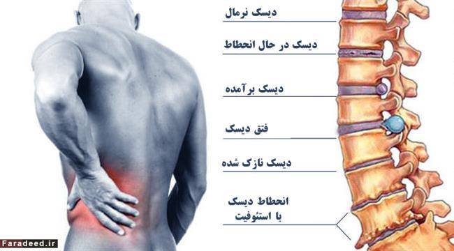 دلایل و درمان‌های کمردرد