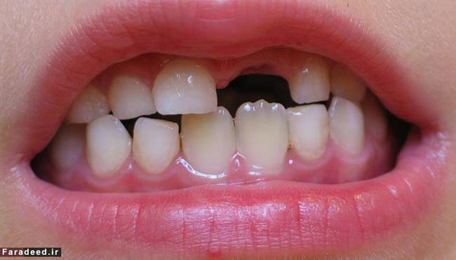 پوسیدگی دندانهای شیری