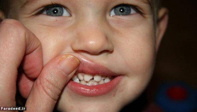 پوسیدگی دندانهای شیری