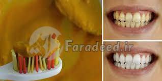سفیدکننده‌های طبیعی دندان