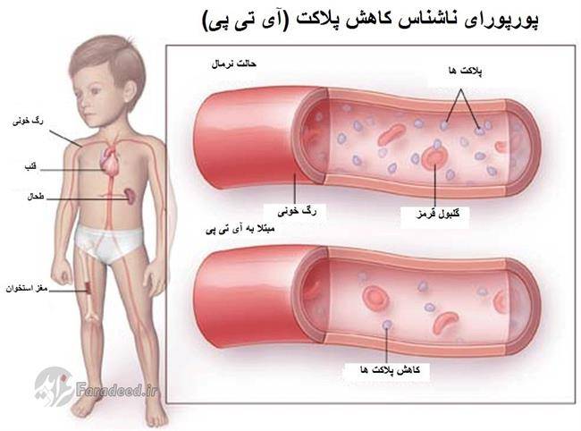 راه های تشخیص و درمان آی تی پی