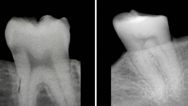 تشخیص کمبود ویتامین D از عکس رادیولوژی دندان!