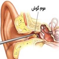 عوارض تجمع چربی در گوش