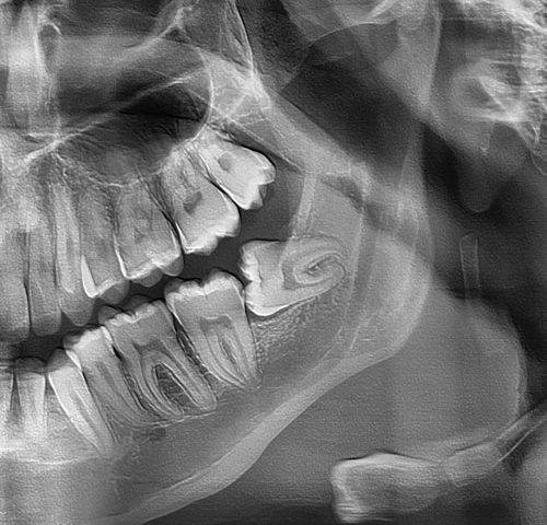 چرا باید دندان عقل را بکشیم؟