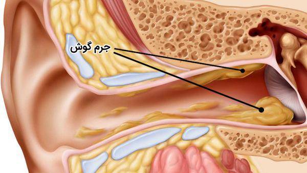 عوارض تجمع چربی در گوش