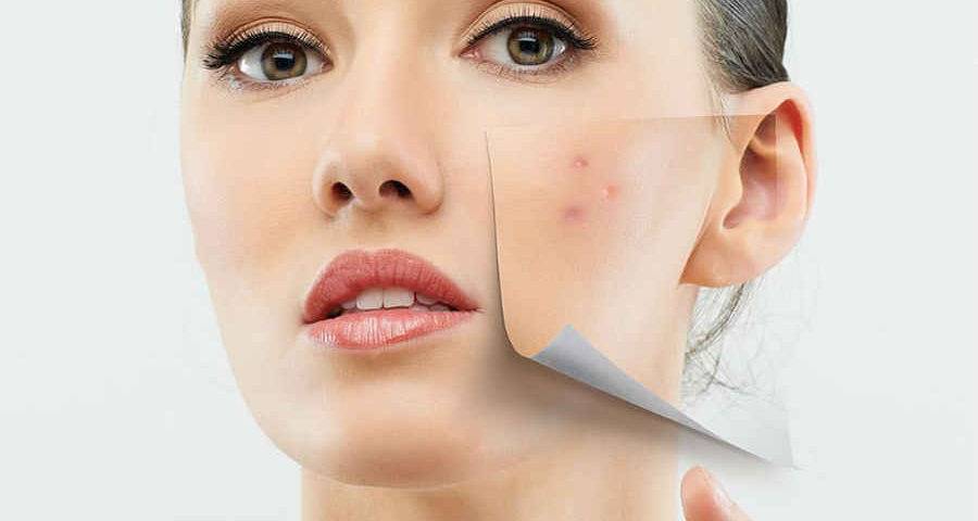 روش‌های خانگی فوق‌العاده موثر برای درمان آکنه و جوش صورت
