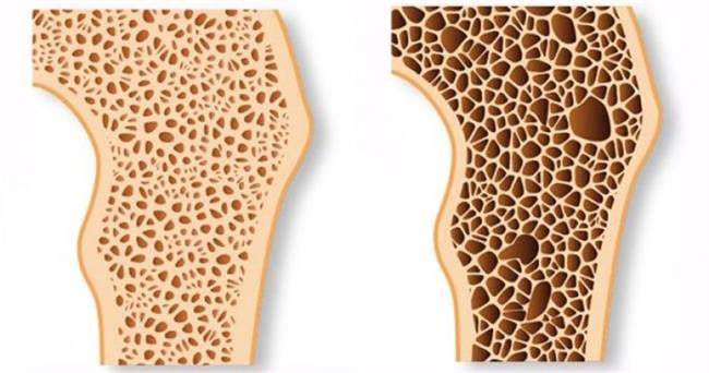 16 درمان موثر پوکی استخوان