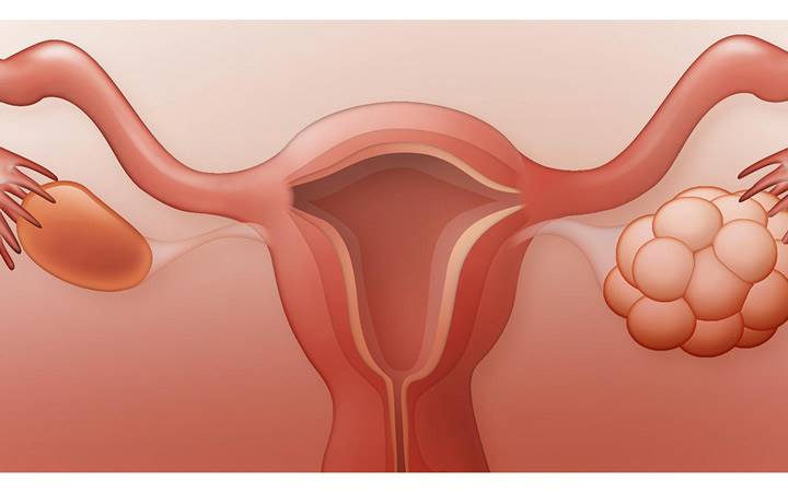 تنبلی تخمدان یا تخمدان پلی کیستیک؛ علائم، دلایل و راه‌های درمان