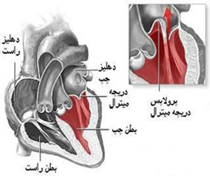 پرولاپس(افتادگی)دریچه قلب:علل،علائم و عوارض آن