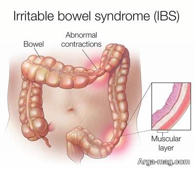 دلایل ابتلا به سندرم روده تحریک پذیر