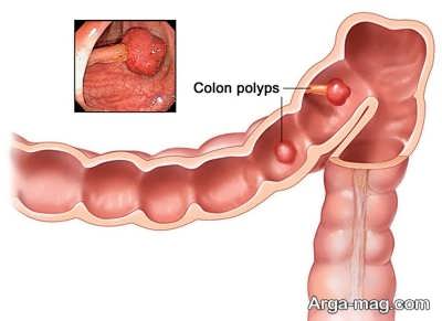 مهم ترین علائم پولیپ روده بزرگ