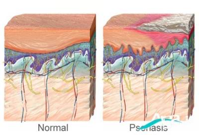 بیماری پوستی پسوریازیس 