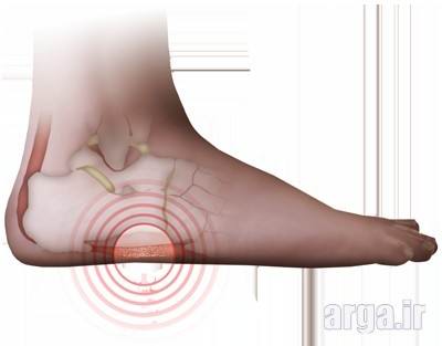 علت درد پاشنه پا