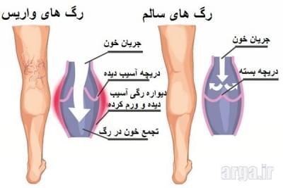 درمان واریس پا