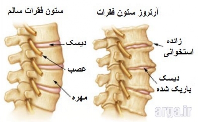 آرتروز