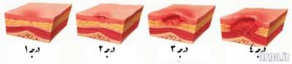 زخم بستر یا فشار