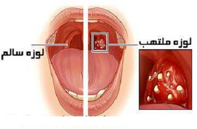 آشنایی با انواع روشهای برداشتن لوزه ها