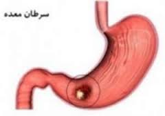 آیامیتوان از سرطان معده پیشگیری کرد؟