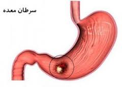 علائم، تشخیص و پیشگیری از سرطان معده