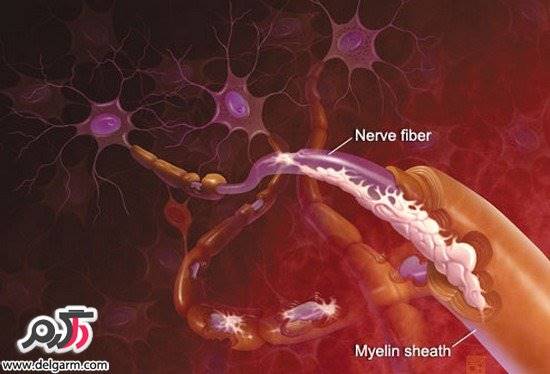 روشهایی برای درمان بیماری ام اس