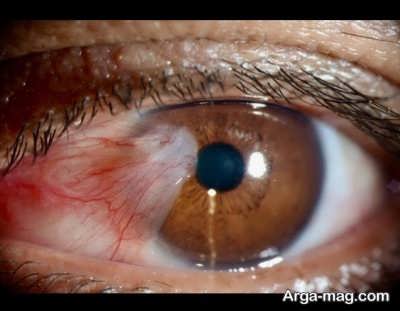 راه های درمان تومور چشمی