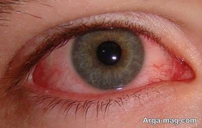 روش های تشخیص بیماری تومور چشمی
