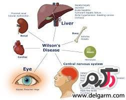 بیماری ویلسون