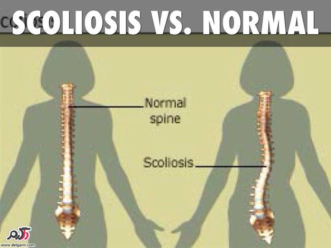 اسکولیوز چیست