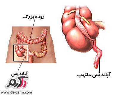 آپاندیسیت