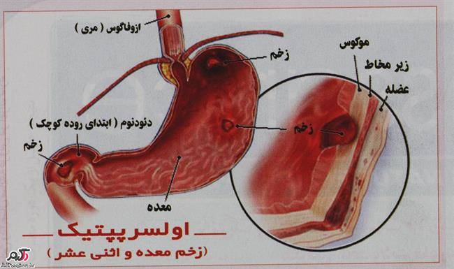 کیسه صفرا