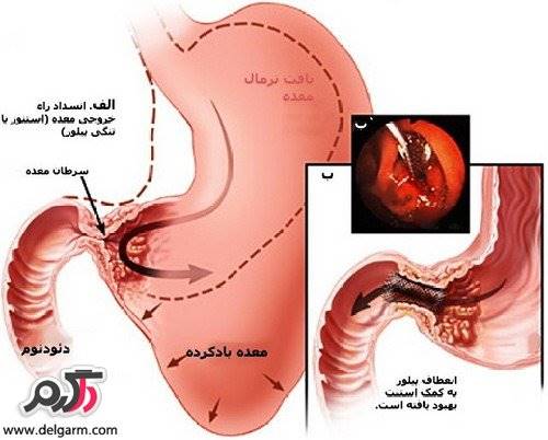 علائم زخم معده