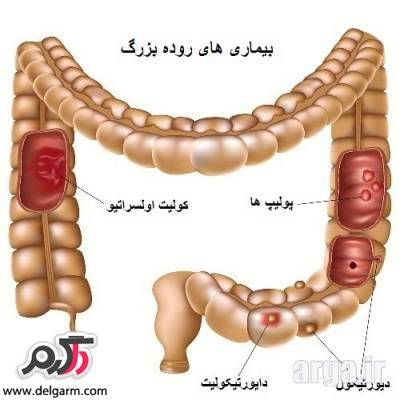 درمان روده بزرگ