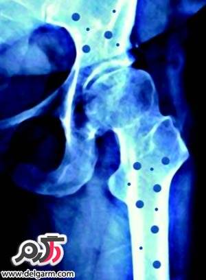 چگونه پوکی استخوان درمان میشود؟/کاملترین مقاله از درمان پوکی استخوان