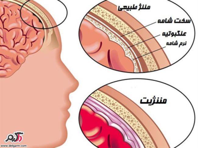 بیماری مننژیت