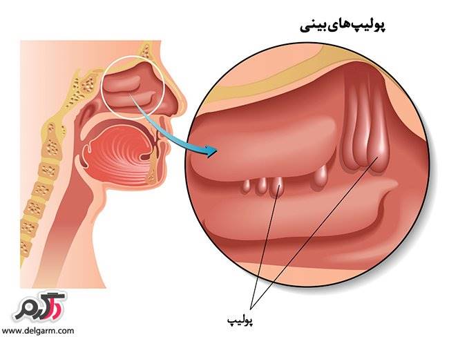 درمان پلیپ بینی