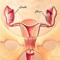 علائم و نشانه های سرطان تخمدان