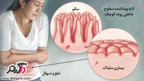 علایم و راه درمان بیماری سلیاک چیست؟