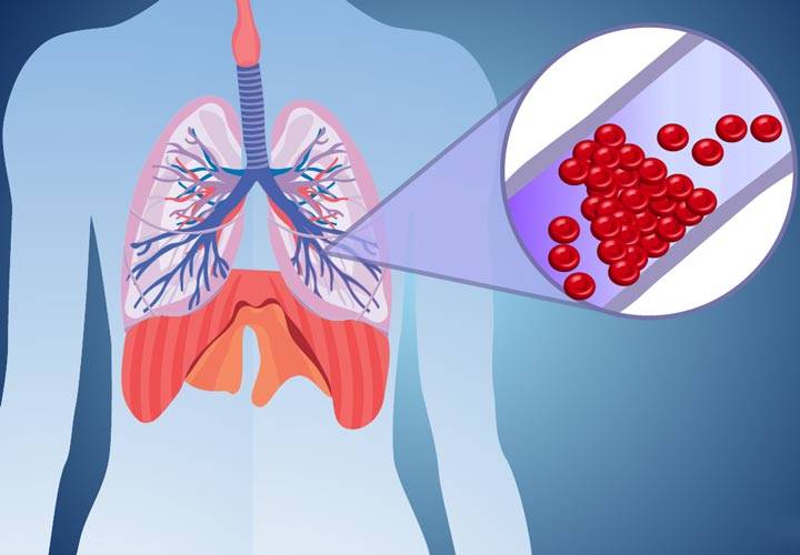 آمبولی ریه چیست؛ از نشانه‌‌ها تا تشخیص و درمان