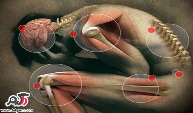  روماتیسم مفصلی را چگونه درمان کنیم؟