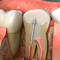 هرآنچه باید درباره عصب‌کشی دندان‌ها بدانید