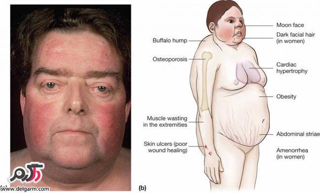 Cushing's syndrome