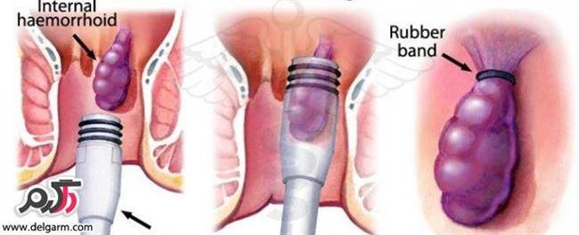 درمان بواسیر بدون عمل جراحی