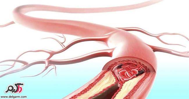 علت غلیظ شدن خون و راه درمان غلظت خون چیست؟