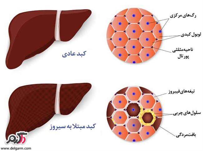 10 نشانه بیماری سیروز کبدی