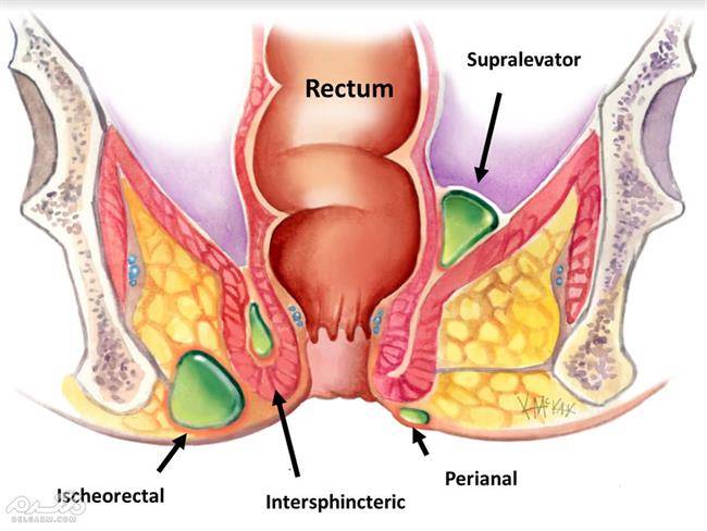 Anal abscess