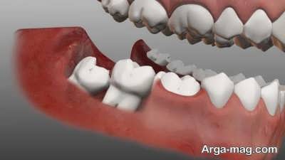 آشنایی با عوارض جراحی دندان عقل
