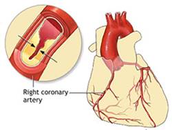 گرفتگی عروق قلب