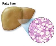 چگونه به بیماری کبد چرب مبتلا می‌شویم؟
